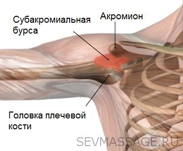 Хруст в лопатке при вращении плечом причины и лечение